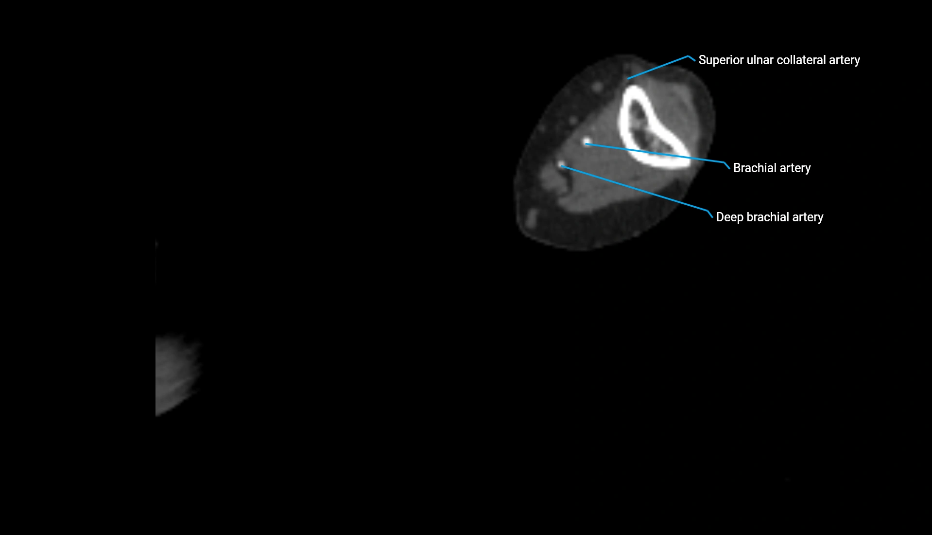 CTA upper limb axial cross sectional anatomy labelled image 202 (2).webp